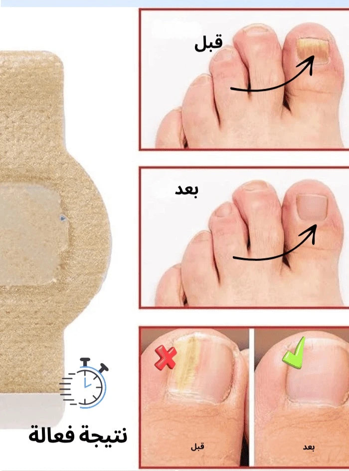 Nail Save Patches حماية الأظافر